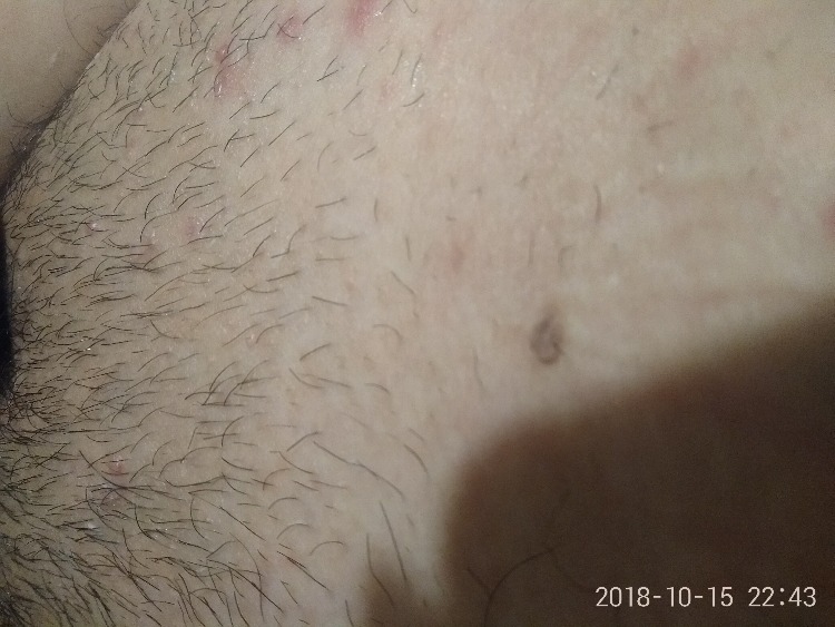 求解吧医,小腹到阴毛部位的红点,有图,不知道是怎么回事