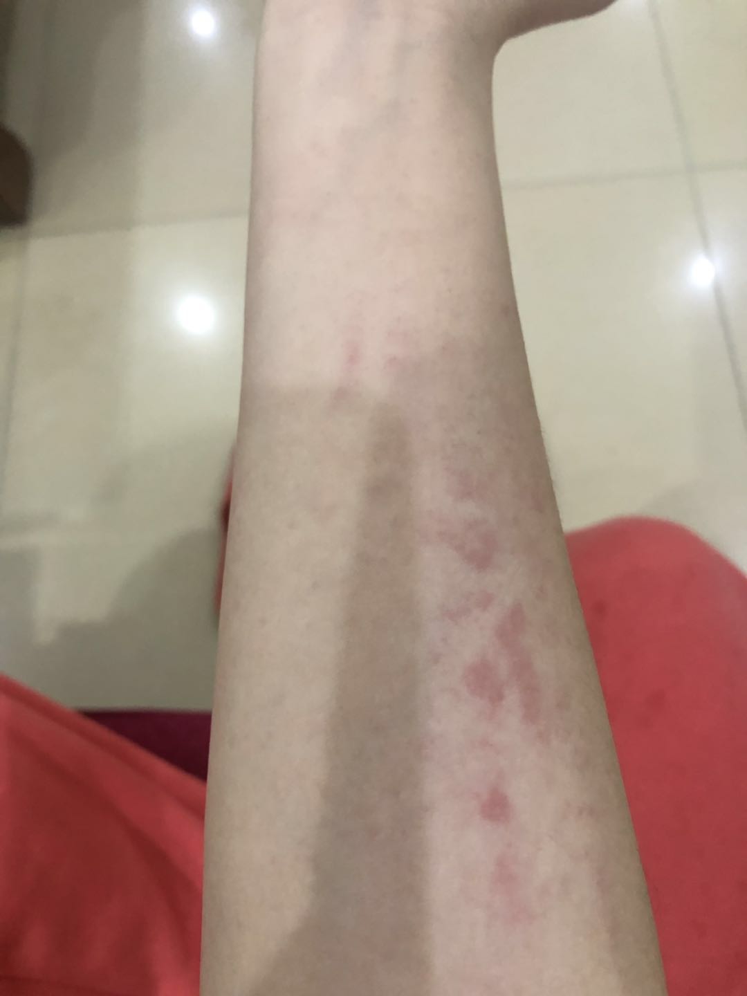 【遗传季节性皮肤过敏】怎么解决?