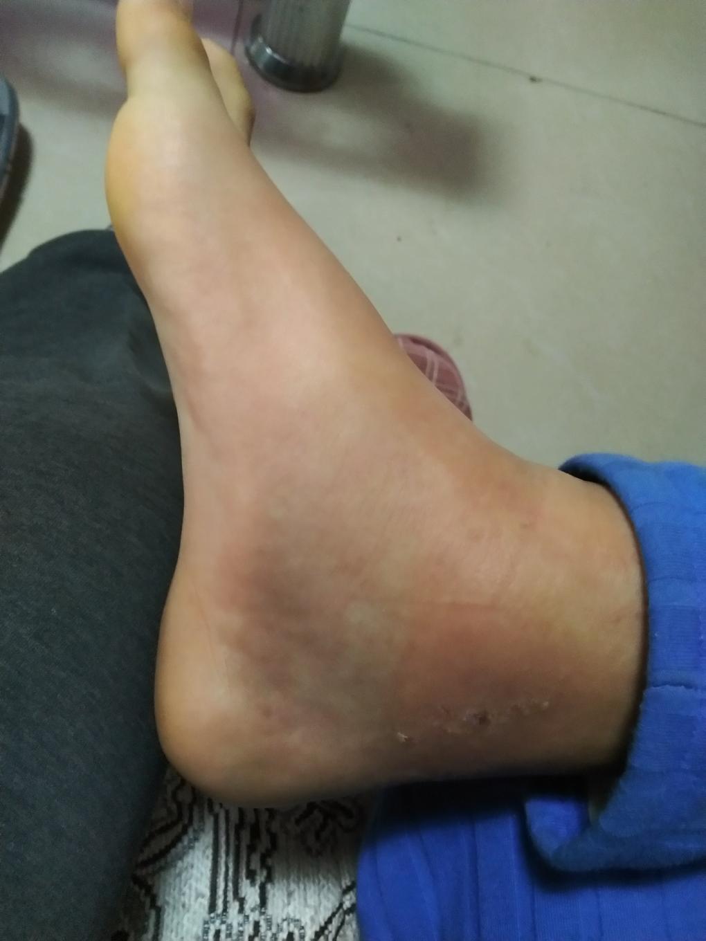 孩子脚脖子肿了