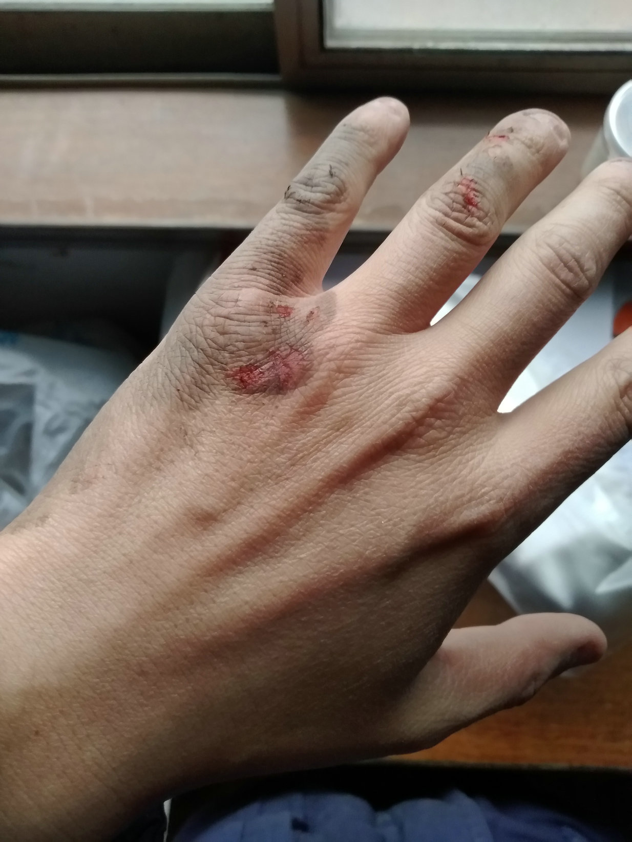 [大家谈谈] 下午5点开摩托车出门,结果侧滑,身上皮全部蹭破了.求 .