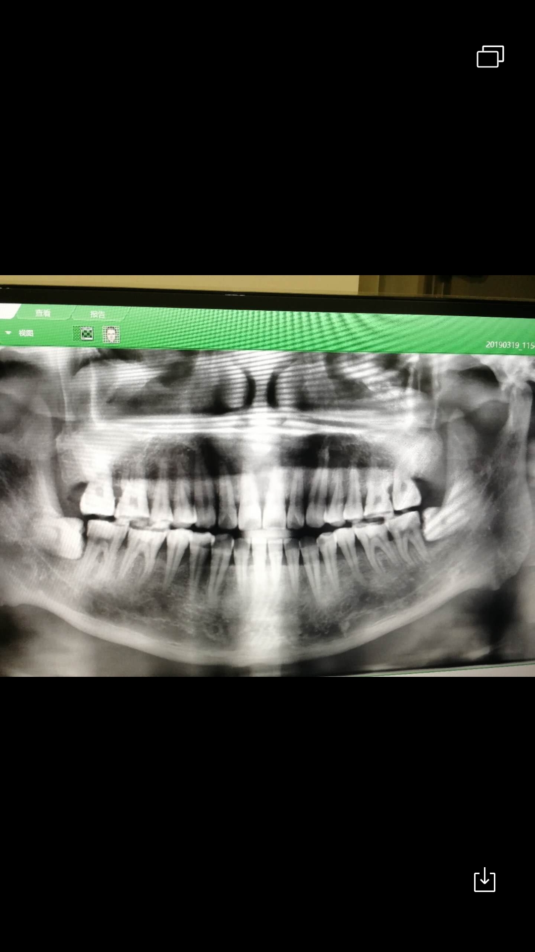 今天给智齿照个ct,明天就去拔了它.