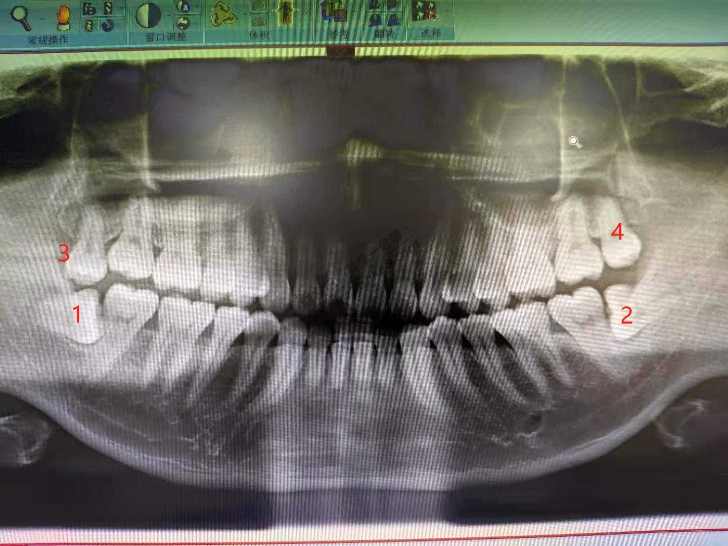 拔完4颗智齿-分享一下-惠小助(52huixz.com)