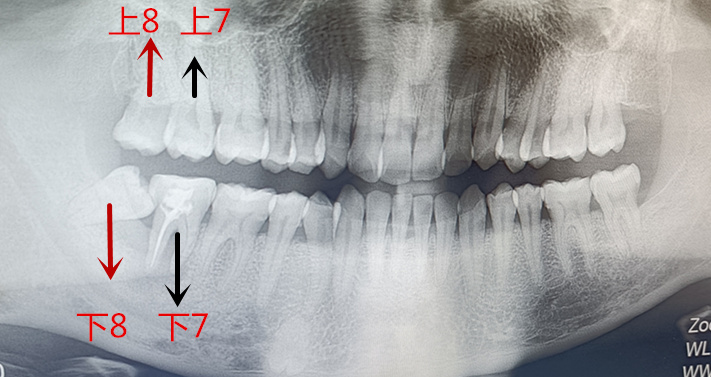 问下7号8号牙齿的问题~该怎么拔或者怎么处理最合理~（有牙片））-惠小助(52huixz.com)
